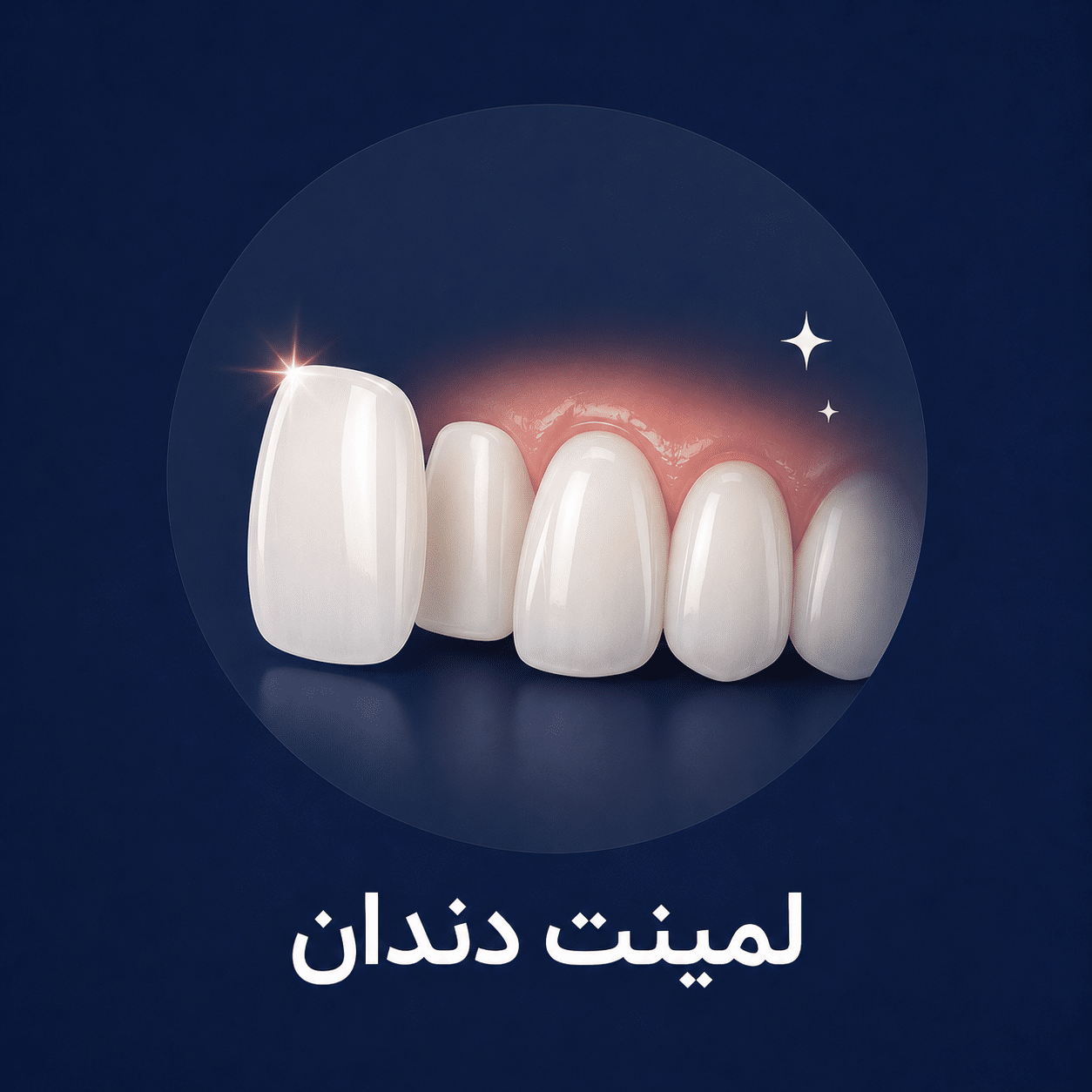 لمینت دندان